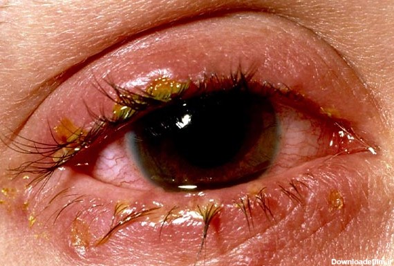 التهاب قرنیه یا کراتیت در اثر عفونت‌های باکتریایی در این تصویر قابل مشاهده است.