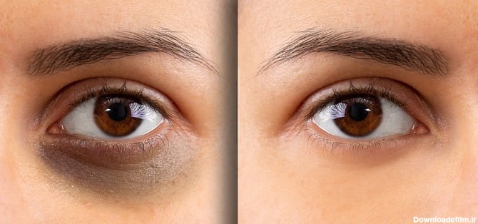 کلینیک لیزر | رفع سیاهی دور چشم