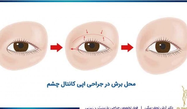 محل برش پلک و زاویه داخلی چشم در جراحی اپی کانتال چشم