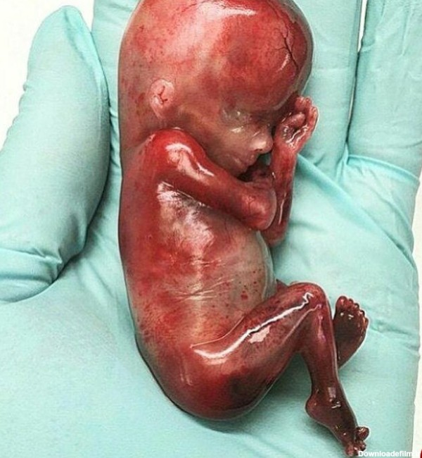 عکس جنین سقط شده هفته اول