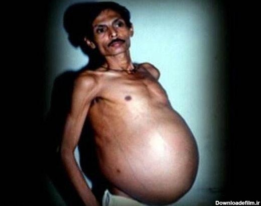 مرد هندی ۳۶ سال از بارداری اش بی خبر بود! (+عکس) | عصر ترکیه