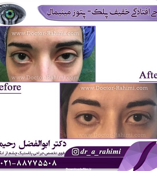 درشت کردن چشم بایگانی - جراح و متخصص چشم و صورت