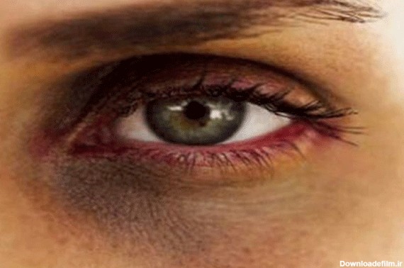 سیاهی دور چشم را با این روش‌ها درمان کنید - همشهری آنلاین