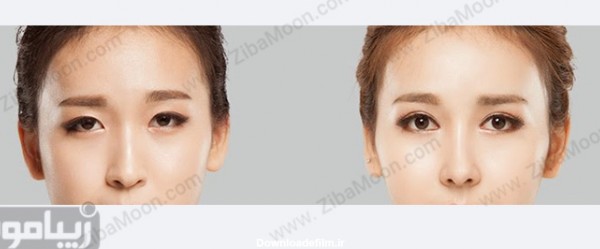 عکس قبل و بعد از عمل چشم کانتوپلاستی