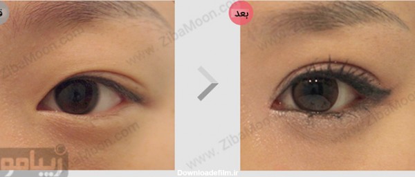 عکس قبل و بعد از عمل درشت کردن چشم