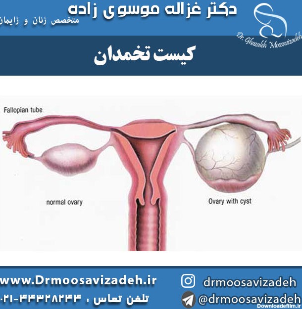 کیست تخمدان و علائم آن - دکتر غزاله موسوی زاده