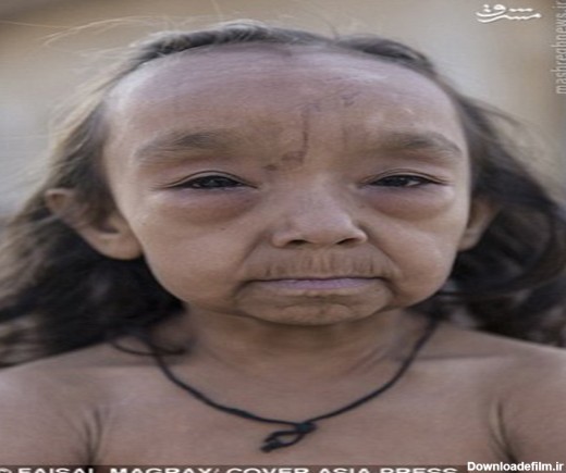 عکس/ بیماری عجیب و غریب خواهر و برادر خردسال هندی