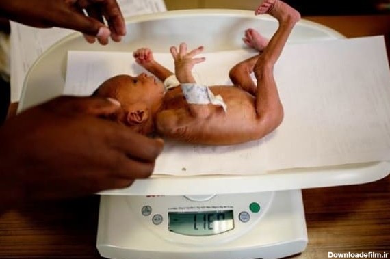 وزن كم نوزاد هنگام تولد (LBW) چه تاثيری بر سلامت نوزاد دارد ...