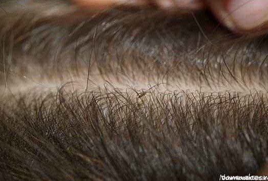شپش موی سر و درمان سریع و قطعی آن + درمان خانگی شپش