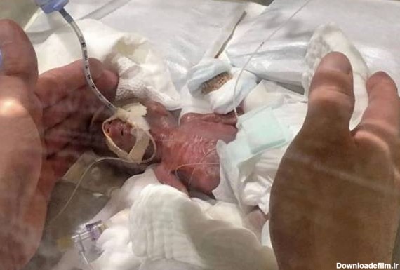 تولد کوچک ترین و ریز ترین نوزاد دنیا + تصاویر شگفت انگیز
