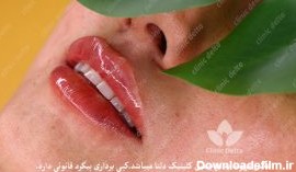 ژل لب مدل طبیعی - کلینیک دلتا