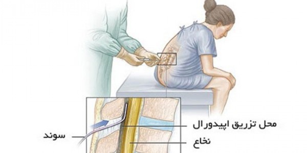 زایمان طبیعی بدون درد به روش اپیدورال - بیمارستان تخصصی عسکریه اصفهان