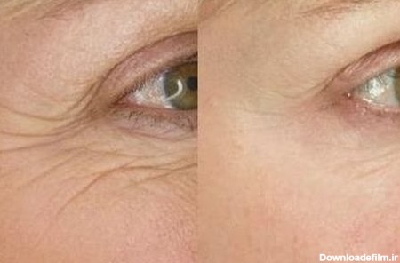 درمان و رفع چین‌ و چروک دور و زیر و بالای چشم - دکتر سهرابی جراح بینی