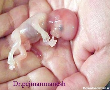 عکس جنین پنج ماهه سقط شده