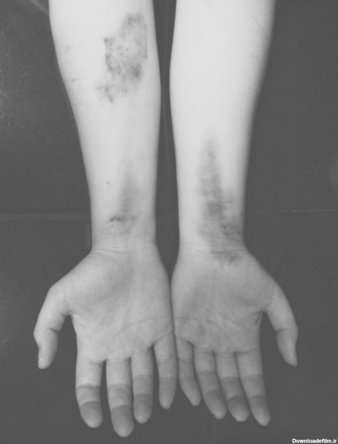 کبودی سیاه سفید دست - عکس ویسگون