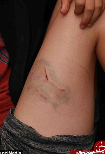 حمله هولناک سگ به پسربچه 9 ساله +تصاویر