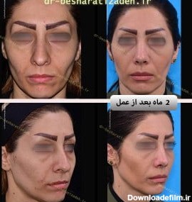 جراحی نوک بینی + عکس قبل و بعد + توضیحات کامل توسط دکتر روزینا ...