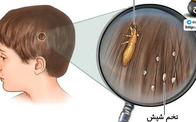 درمان خانگی شپش موی سر