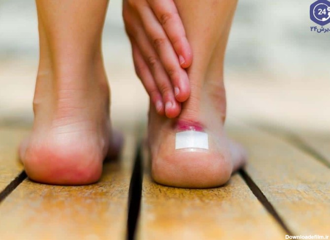 دلایل بروز تاول پا و روش های درمان آن چیست؟ | پذیرش۲۴