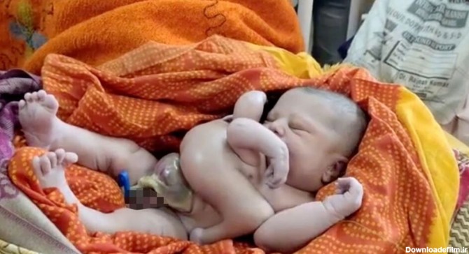 تولد نوزاد عجیب الخلقه چهار دست و پا در هند + تصویر