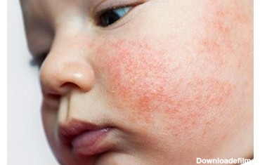 آلرژی های پوستی نوزادان به چه شکل ظاهر می شوند؟