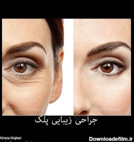 جراحی زیبایی پلک در اصفهان سیر تا پیاز | دکتر علیرضا مجلسی