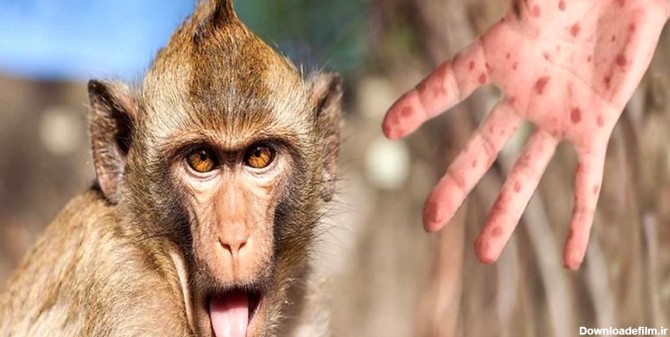 افزایش شمار مبتلایان به آبله میمون در جهان به بیش از 13 هزار ...