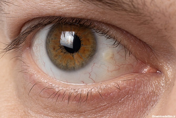 انواع تومورهای ملتحمه چشم