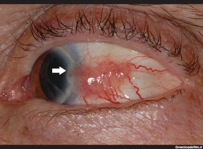 تومورهای بدخیم ملتحمه چشم