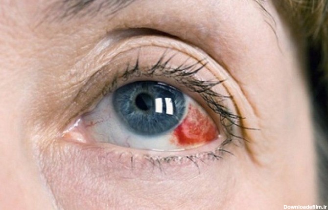 لکه های قرمز داخل چشم چه رازهایی درباره سلامت شما دارند ...