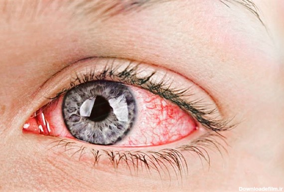 قرمزی چشم یا چشم خونی (Red Eye) و تحریک پذیری آن | دکتر مریم ...