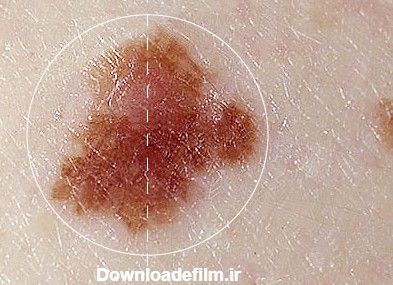 تصاویر ضایعات پوستی پیش سرطانی و سرطان پوست | انواع سرطان پوست با عکس