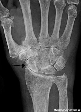 درد مچ دست ، علت و درمان آن - دکتر سیامک مرادی، فوق تخصص درد