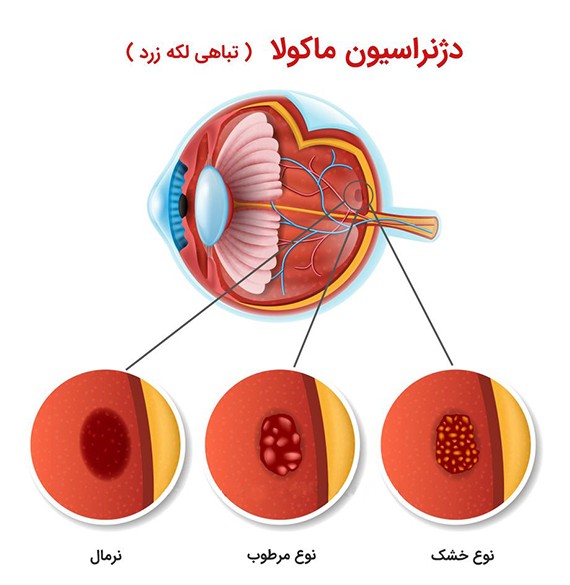 بیماری‌های شبکیه - مرکز چشم پزشکی سلامت غرب تهران
