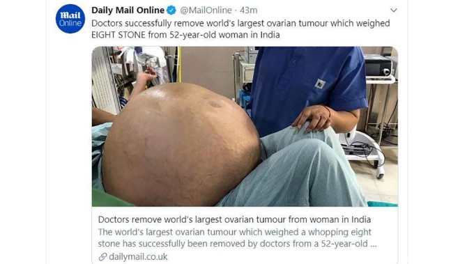 خارج کردن بزرگترین تومور تخمدان از شکم یک زن 52 ساله + عکس