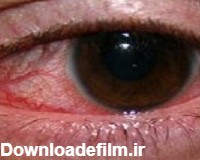 7 علت رایج لکه های خونی داخل چشم