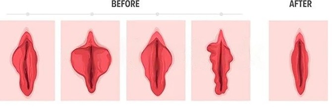 قبل و بعد لابیاپلاستی و جراحی زیبایی واژن