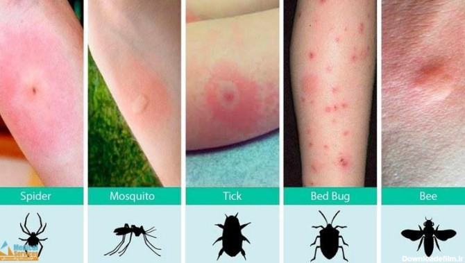 عفونت های پوستی ناشی از نیش حشرات