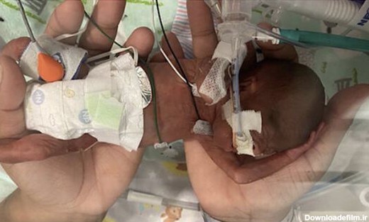 نارس ترین نوزاد دنیا در ۲۱ هفتگی متولد شده است! - خبرگزاری مهر ...
