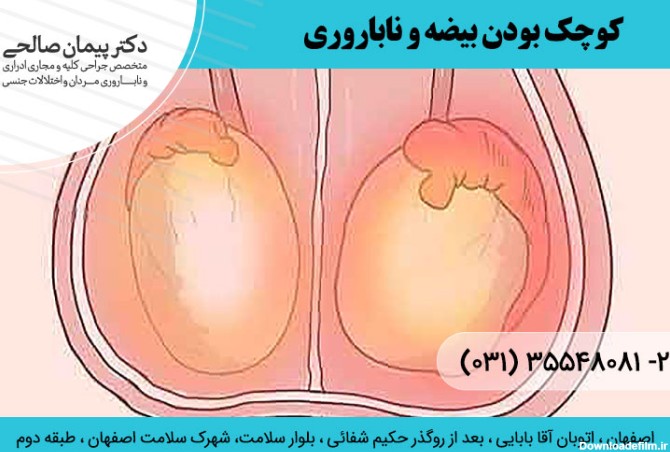 درمان کوچکی بیضه | متخصص اورولوژی اصفهان | دکتر پیمان صالحی | بورد ...