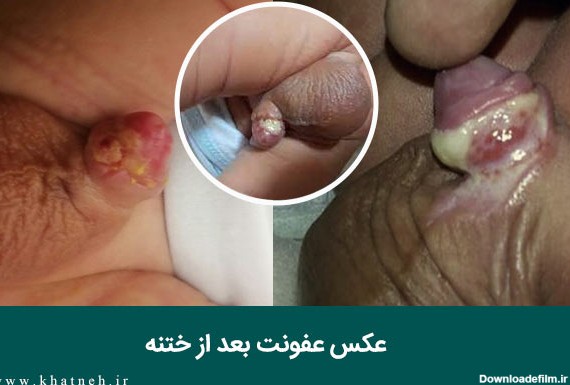 نشانه های عفونت بعد از ختنه با حلقه | دکتر امیری