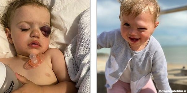 عارضه عجیبی که باعث خون گریه کردن کودک ۲ ساله می‌شود+تصاویر
